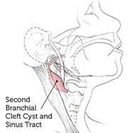 Diagram showing location of a second branchial cleft cyst and sinus tract