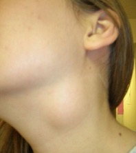 Photo of a neck with a visible branchial cleft cyst