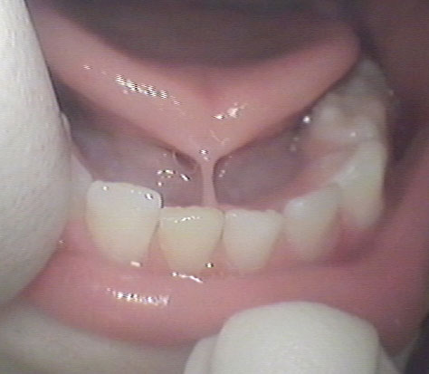 Photo showing a tongue tie