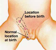 Diagram of of testis location before birth and normal location at birth